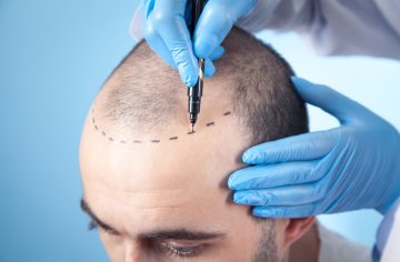 20 Fragen zur Haartransplantation